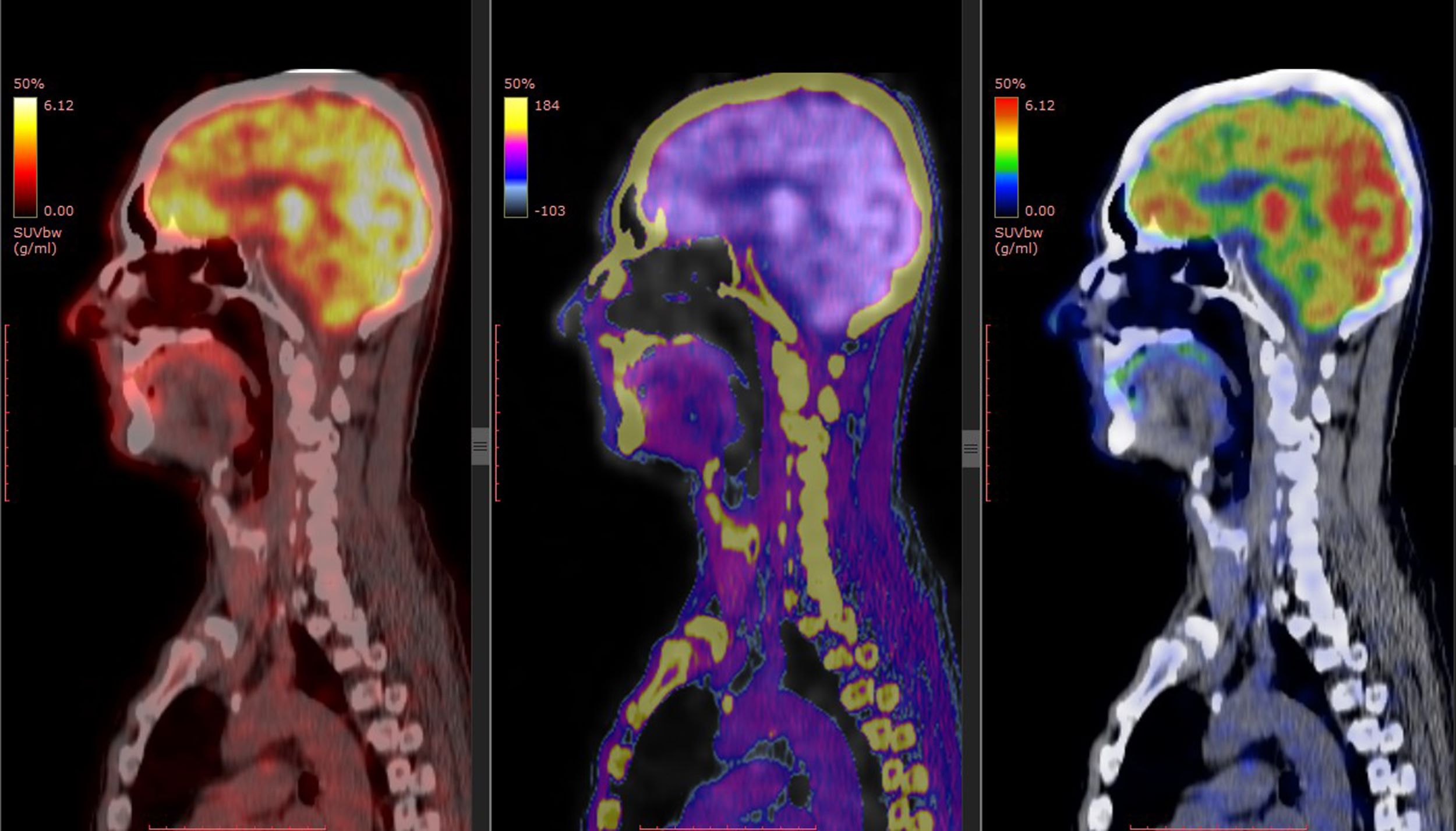 AI diagnoses rare diseases more accurately